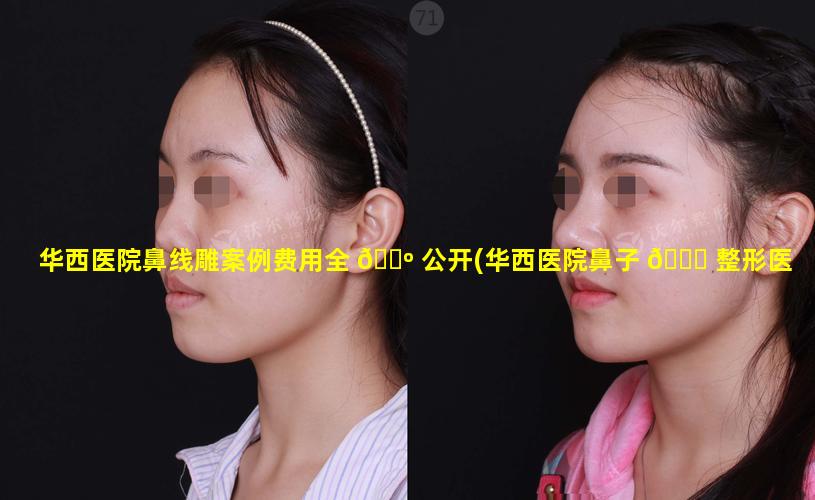 华西医院鼻线雕案例费用全 🌺 公开(华西医院鼻子 💐 整形医生最好的)